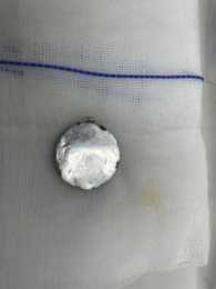 3歲娃誤吞紐扣電池近三個月 取出時食管險被腐蝕穿孔