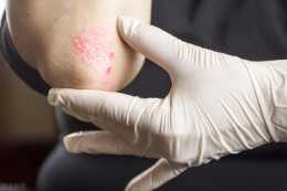 銀屑病和溼疹有什麼區別？學會這1點，分清溼疹與銀屑病