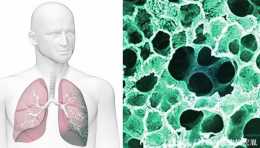 肺纖維化——“類似癌症”結局一種疾病？