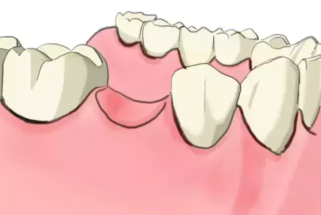 手繪圖文為您講解：傳統鑲牙和種植牙的區別