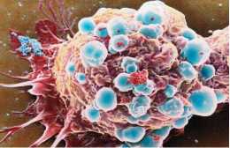 癌胚抗原高不一定有事，但腫瘤患者癌胚抗原高，一定出事！