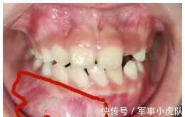 孩子替牙期，牙醫讓給孩子拍一張“曲面斷層片”，不是為了掙你錢