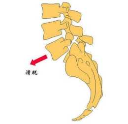 「骨科專家說給你聽」腰椎滑脫了能不能靠按摩、正骨按回去？