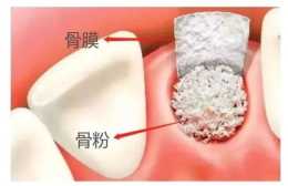為什麼種植醫生告知需要新增骨粉再種牙？