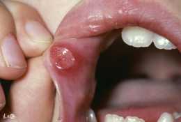 反覆口腔潰瘍小心“白塞”病